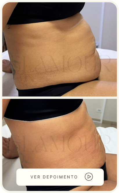 Antes e depois real da paciente, caso 1