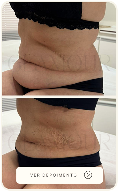 Antes e depois real da paciente, caso 2