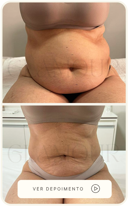 Antes e depois real da paciente, caso 3