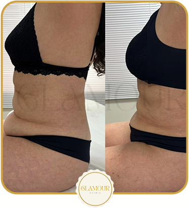 Antes e depois real: abdômen e contorno corporal