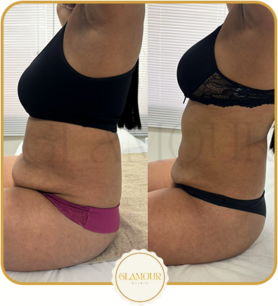 Antes e depois real: remodelação corporal